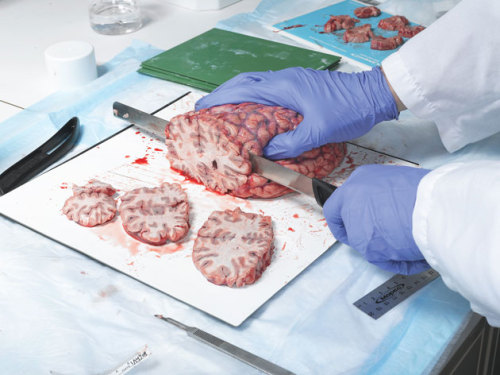 A human brain being dissected into serial sagittal sections.