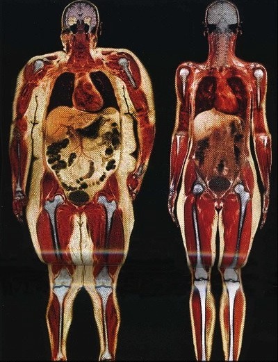 Celebrity Weight Gain on Snakesonacane Mri Of Two Female Patients   250lbs Compared To