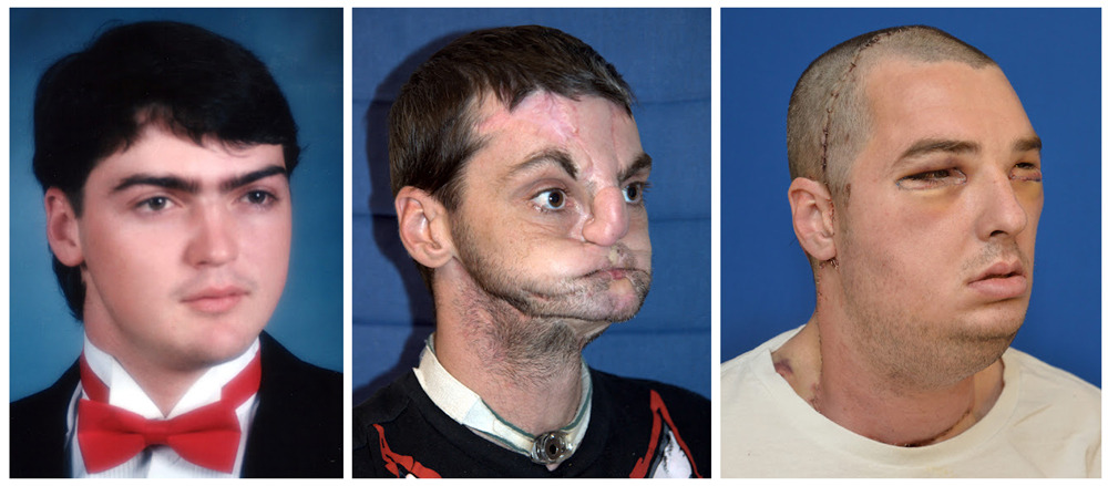 Gunshot victim undergoes ‘most extensive’ face transplant everSurgeons have detailed what they claim is the world’s most comprehensive face transplant — allowing a 37-year-old man to emerge from behind a mask 15 years after a gun accident almost killed him.Richard Norris of Hillsville, Virginia, was shot in the face in 1997 and lost his nose, lips and most movement in his mouth. Since then, he has had multiple life-saving and reconstructive surgeries but none could repair him to the extent where he felt he could return to society. He wore a prosthetic nose and a mask even when entering hospital for the transplant. (University of Maryland Medical Center/Reuters)