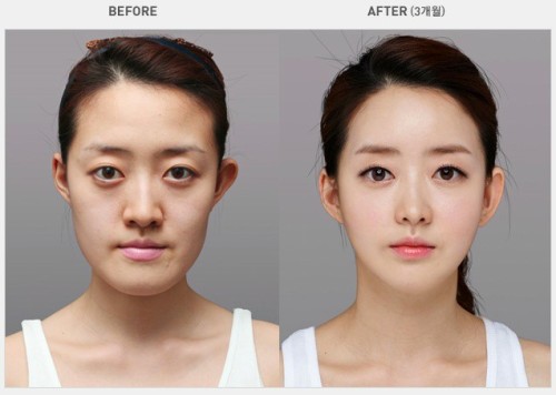 Resultado de imagen para korean surgery