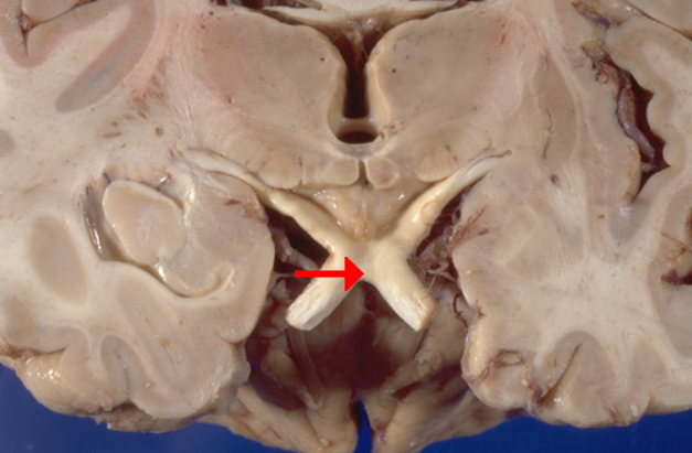 Nervous System - Neuroanatomy - Optic chiasm