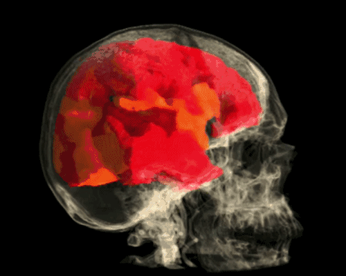 Female Orgasm in Brodmann Brain Regions  Visualization of stimulation in the brain with scans taken over a seven minute sequence - via The Visual MD:  The human brain can be separated into regions based on structure and function - vision, audition, body sensation, etc, known as Brodmann&#8217;s area map. This animation shows the functional magnetic resonance imaging, fMRI, brain data of a participant experiencing an orgasm and the corresponding relationships seen within these different regions based on utilization of oxygen levels in the blood. 20 snapshots in time of the fMRI data are taken from a 7 minute sequence. Over the course of the 7 minutes the participant approaches orgasm, reaches orgasm and then enters a quiet period. Oxygen utilization levels are displayed on a spectrum from dark red (lowest activity) to yellow/white (highest). As can be observed, an orgasm leads to almost the entire brain illuminating yellow, indicating that most brain systems become active at orgasm.  You can see the video at the The Visual MD here [via The Guardian UK]