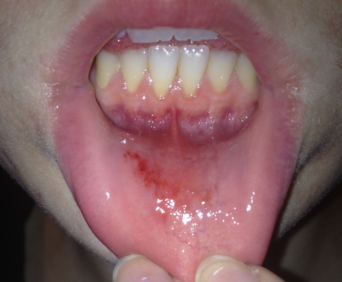 Inflammation Of Mouth 93